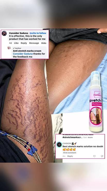 Customer comments praising Radiant Stretch Mark Removal Cream