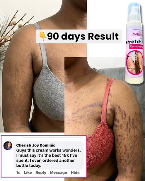 Customer shoulder stretch marks before and after 90 days of using Radiant cream