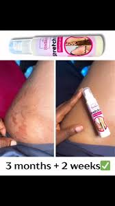 Arm stretch marks faded after 3 months and 2 weeks of using Radiant cream