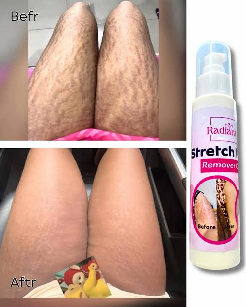 Thigh stretch marks before and after using Radiant cream